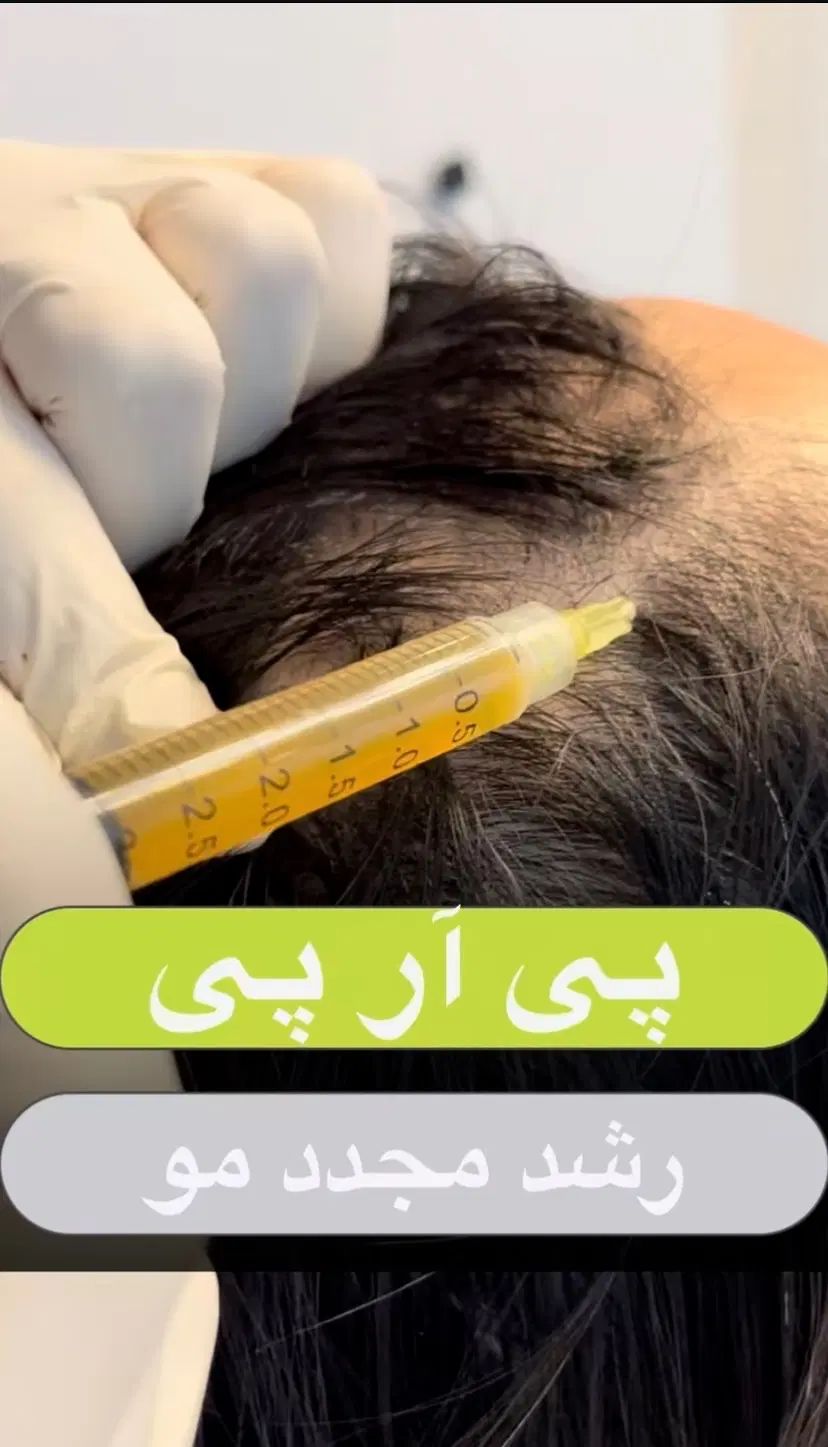 پی آر پی مو وصورت|خدمات آرایشگری و زیبایی|رشت, گلسار|دیوار