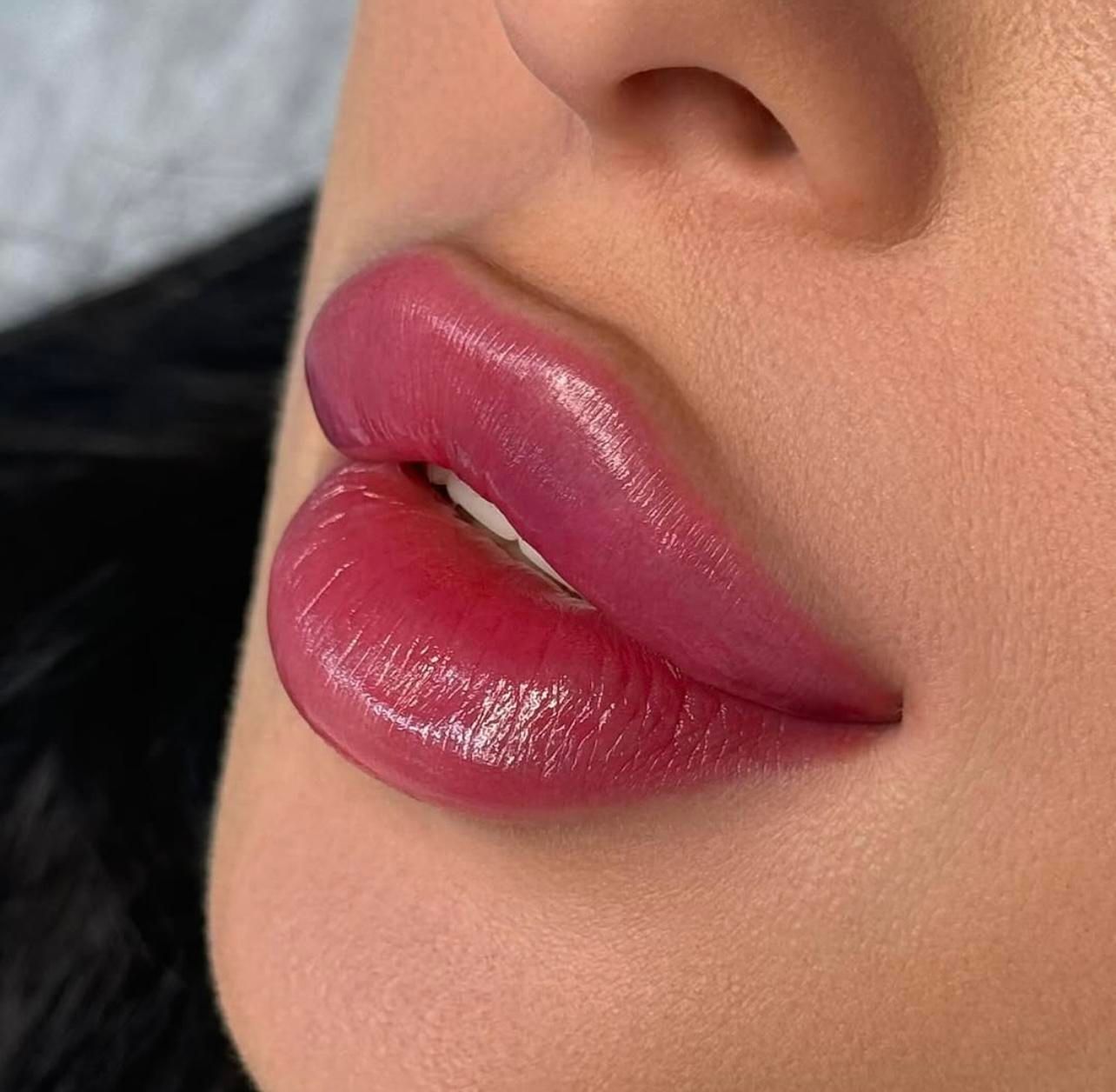 فیلر لب ژل گونه فک بوتاکس لیزرساکشن غبغب کاشت مو|خدمات آرایشگری و زیبایی|رشت, گلسار|دیوار