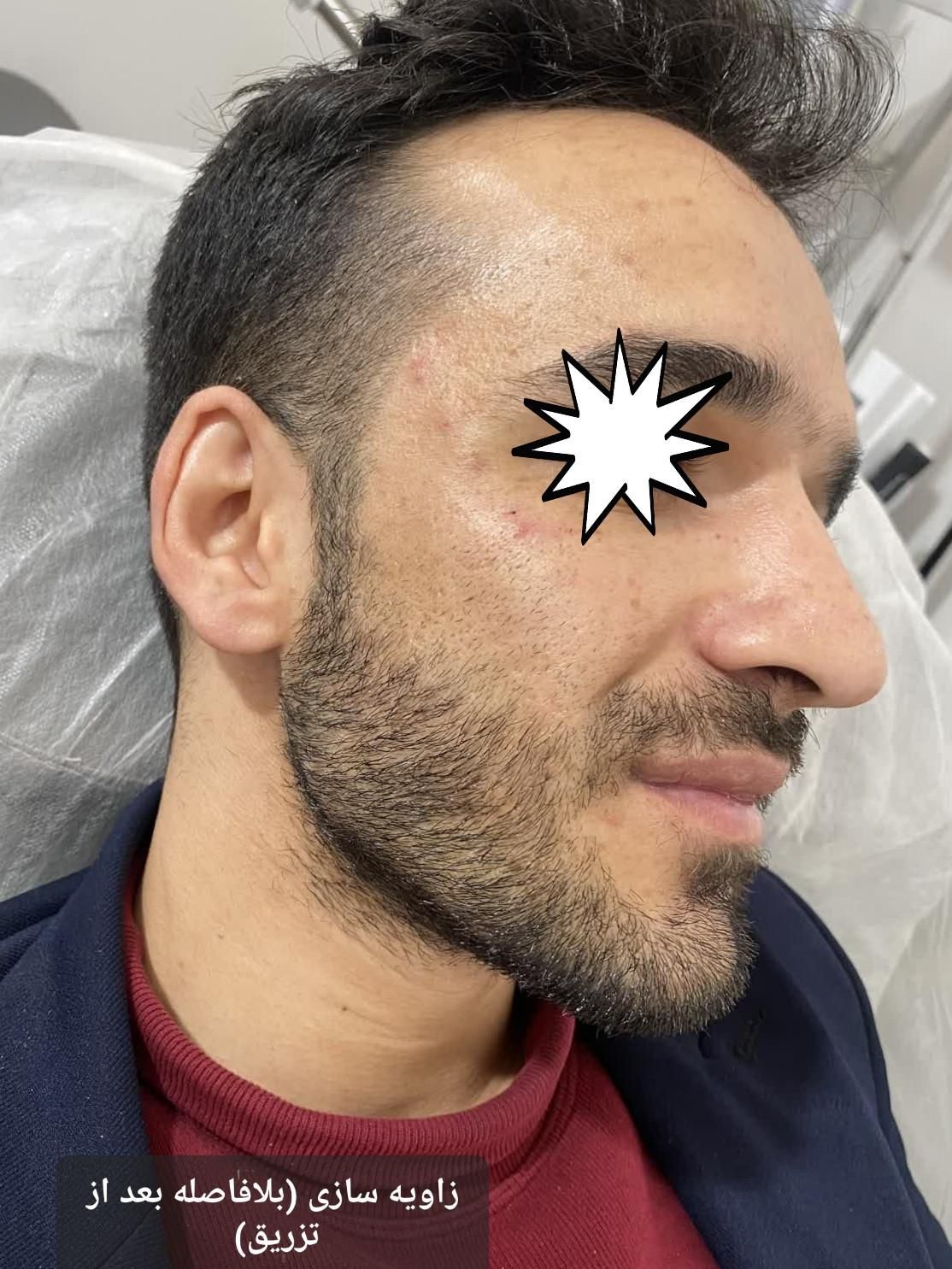 ژل وبوتاکس بلک فرایدی404(اقساط)(توسط پزشک)|خدمات آرایشگری و زیبایی|خرمآباد, |دیوار