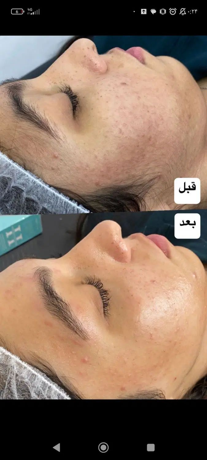 درماپلنینگ (پاکسازی شیوتخصصی صورت)350به مدته محدود|خدمات آرایشگری و زیبایی|محمدشهر, ولدآباد|دیوار