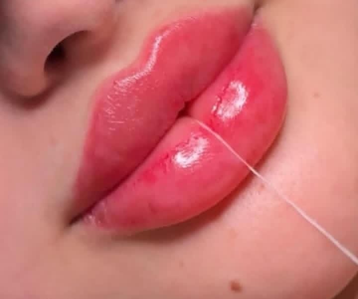 آموزش تزریق ژل و بوتاکس|خدمات آرایشگری و زیبایی|یاسوج, |دیوار