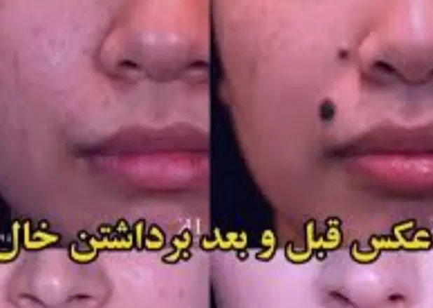 فیشال تخصصی برداشتن خال ولک ،بوتاکس،مزو تراپی،|خدمات آرایشگری و زیبایی|مشهد, حرم مطهر رضوی|دیوار