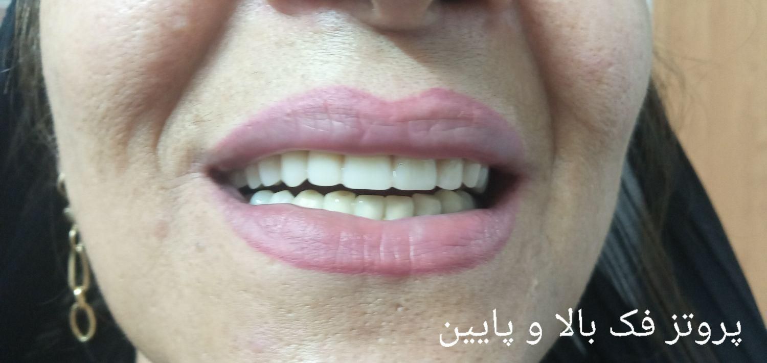دندانسازی ( پروتز متحرک) لمینتی و کامپوزیتی|خدمات آرایشگری و زیبایی|مشهد, احمدآباد|دیوار