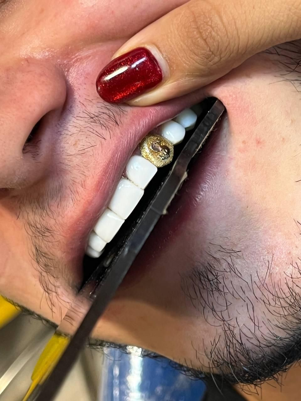 جشنواره کامپوزیت لمینیت عصب IPS IMAX روکش N2 ونیر|خدمات آرایشگری و زیبایی|تهران, هفت حوض|دیوار