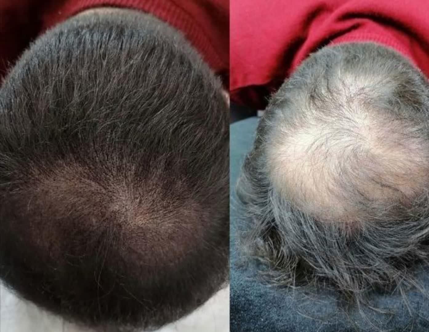 آموزش خدمات میکرواسکالپ کاشت اسکالپ مو تضمینی|خدمات آرایشگری و زیبایی|مشهد, جانباز|دیوار