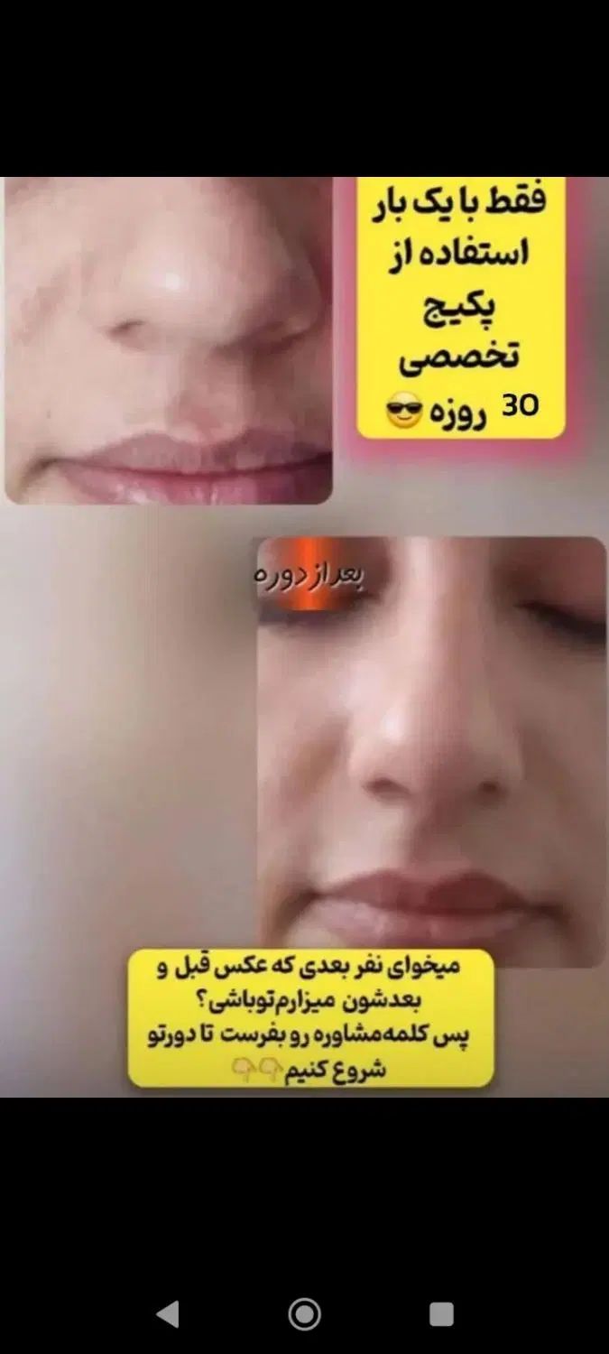 کرم لیفتینگ بینی|آرایشی، بهداشتی، درمانی|رشت, پل تالشان|دیوار