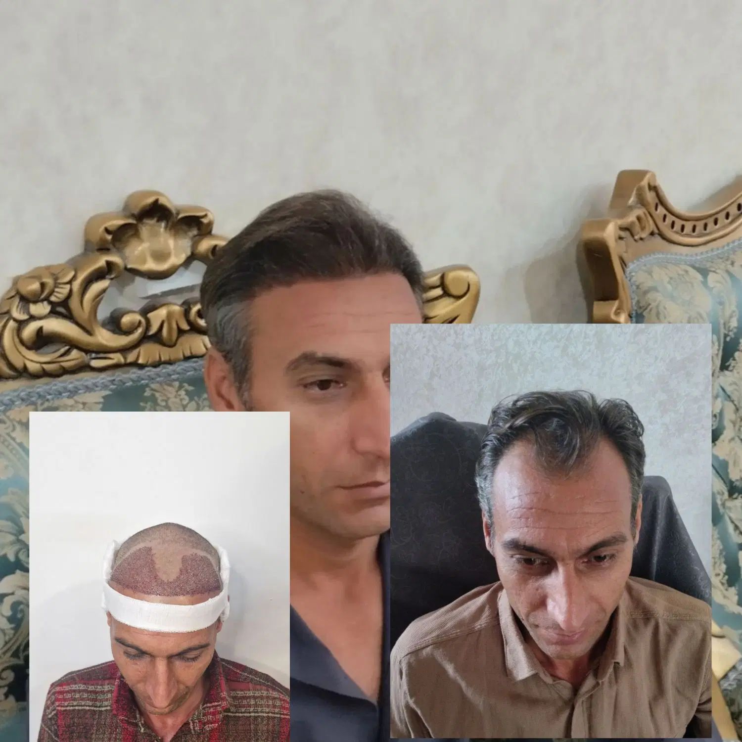 کاشتمو تضمینی و تراکم عالی زیر نظر پزشک|خدمات آرایشگری و زیبایی|مشهد, فردوسی|دیوار