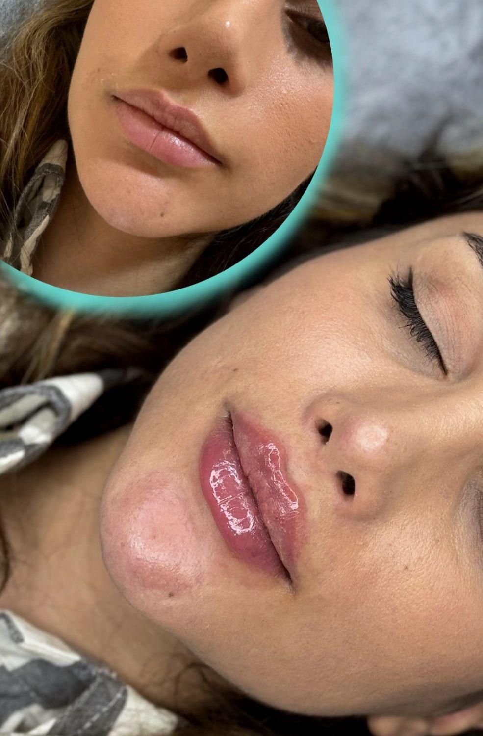 جشنواره فیلر صورت و لب در کلینیک ویرا|خدمات آرایشگری و زیبایی|شهرکرد, |دیوار