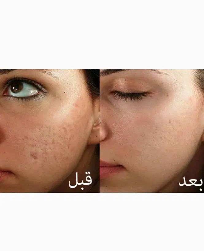 بوتاکس و مزوتراپی میکرونیدلینگ جای جوش و آموزش|خدمات آموزشی|شوش, |دیوار