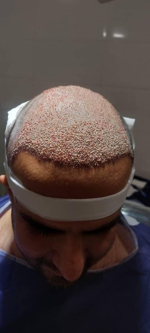 کاشت تخصصی مو در شیراز|خدمات آرایشگری و زیبایی|بوشهر, |دیوار