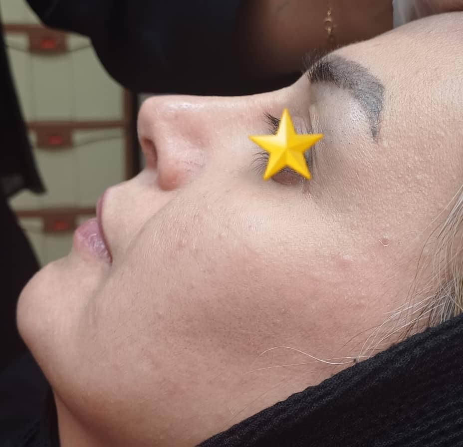 بوتاکس و ژل و لیزر|خدمات آرایشگری و زیبایی|تهران, امیریه|دیوار