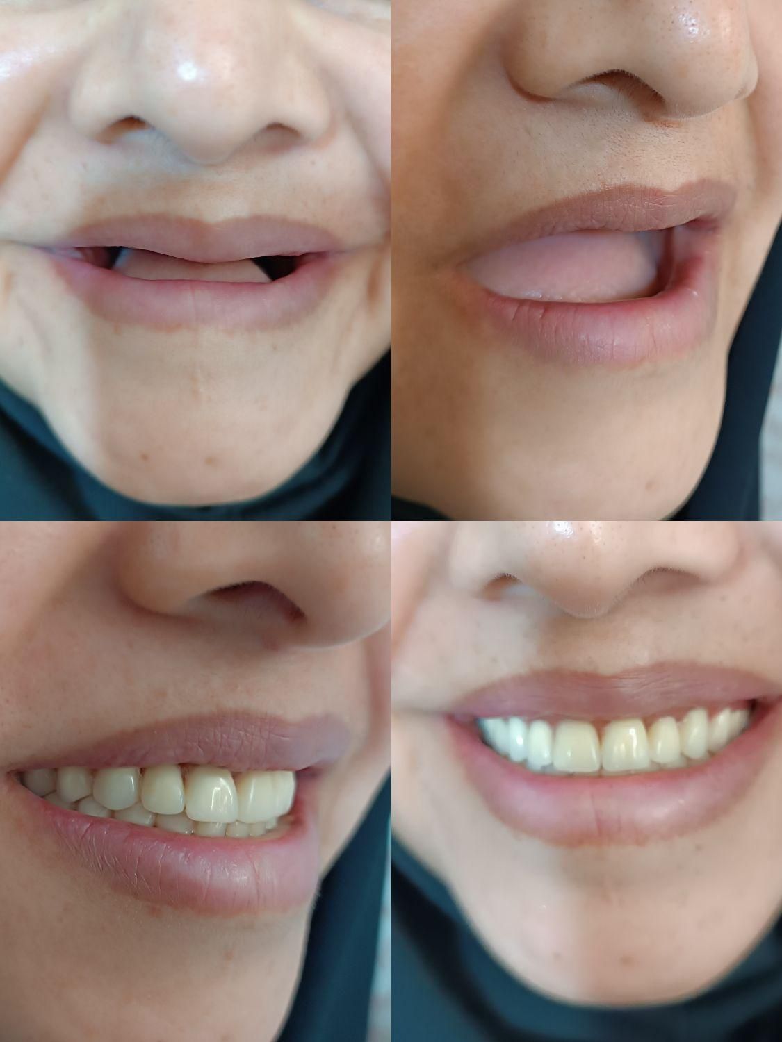 پروتز دندان (دندان مصنوعی)|خدمات آرایشگری و زیبایی|تربت‌حیدریه, بازار|دیوار