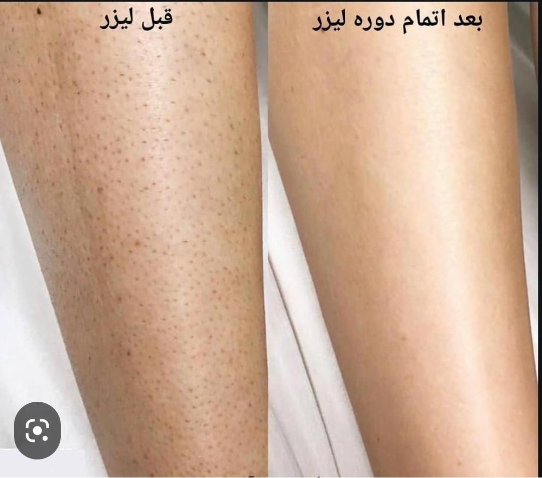 20%تخفیف خدمات پوستی،co2فرکشنال،ریموو تتو،کیوسویج|خدمات آرایشگری و زیبایی|سیرجان, |دیوار