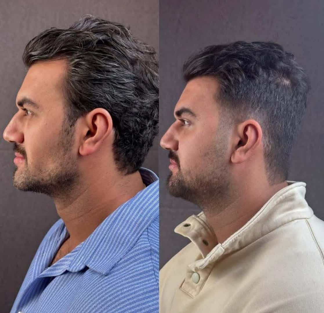 تزریق چربی بوکال فت کاشت مو ساکشن غبغب بلفاروپلاسی|خدمات آرایشگری و زیبایی|اصفهان, ملک‌شهر|دیوار