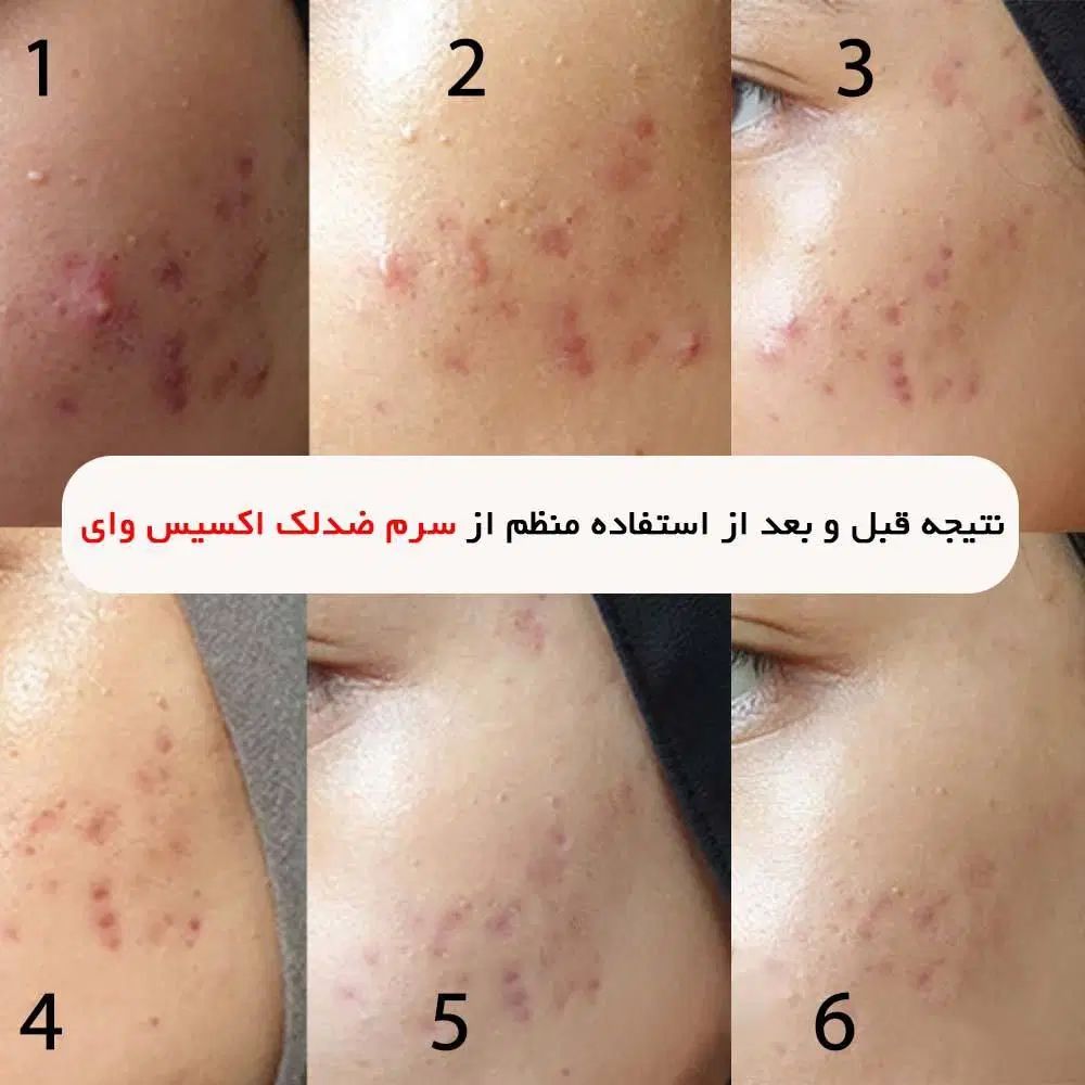 سرخ ضد لک و جوش اکسیس وای اورجینال با ضمانت|آرایشی، بهداشتی، درمانی|فردیس, قریشی|دیوار