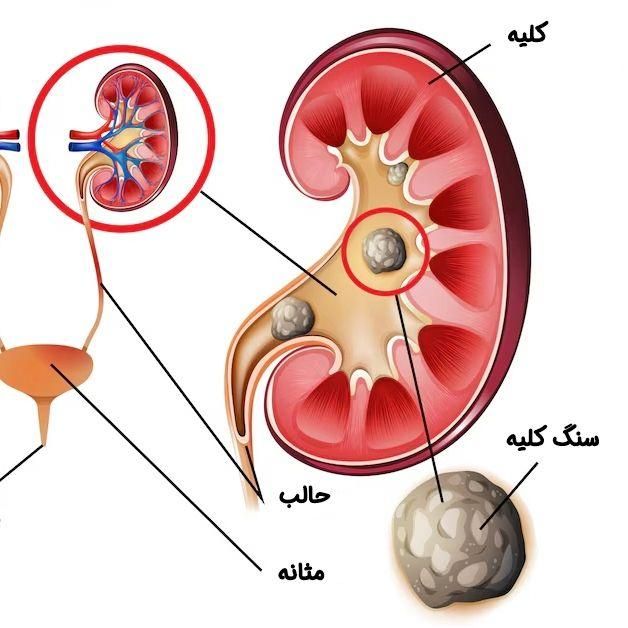 درمان قطعی سنگ کلیه|خدمات آرایشگری و زیبایی|قم, شهرک قدس|دیوار