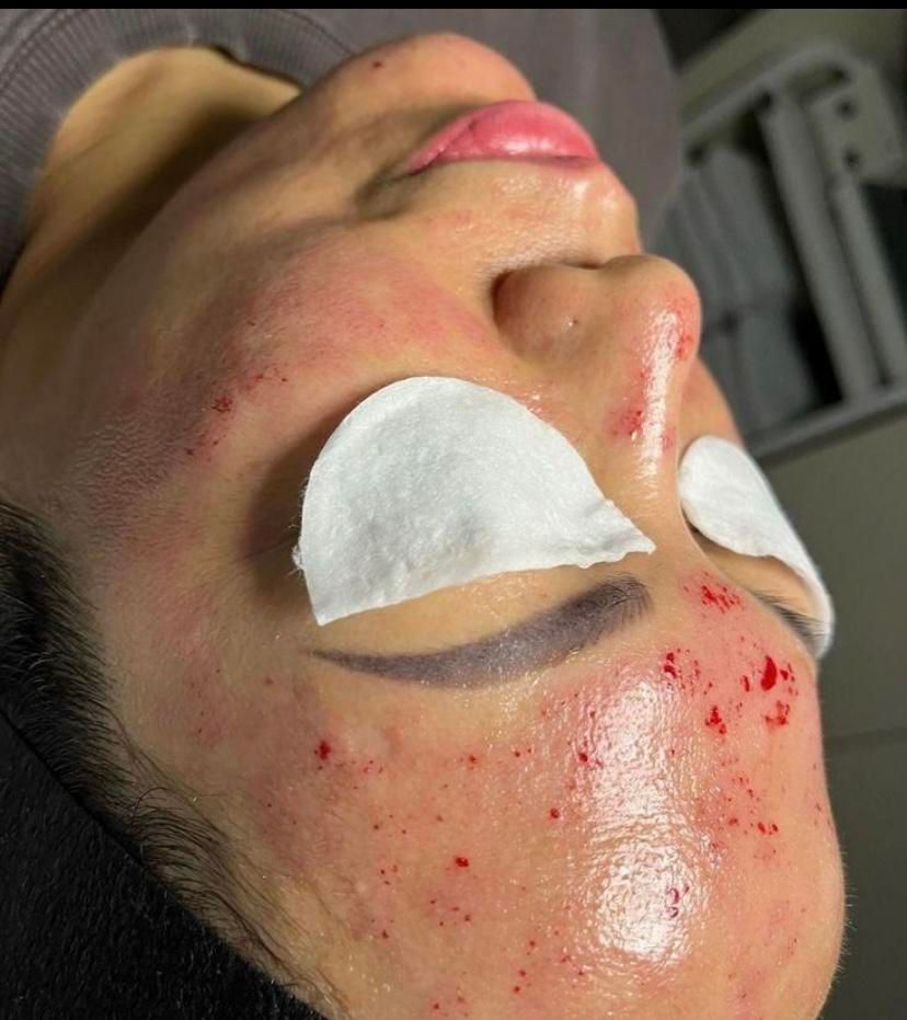 خالبرداری ،رفع کک ومک ،برداشتن میخچه توسط پزشک|خدمات آرایشگری و زیبایی|کرج, شهرک یاس جنوبی|دیوار