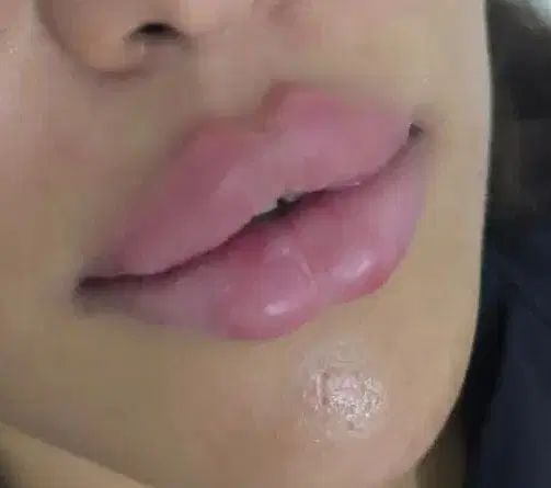 تزریق ژل و بوتاکس  و آموزش دارالرحمه شیراز|خدمات آرایشگری و زیبایی|شیراز, دارالرحمه|دیوار