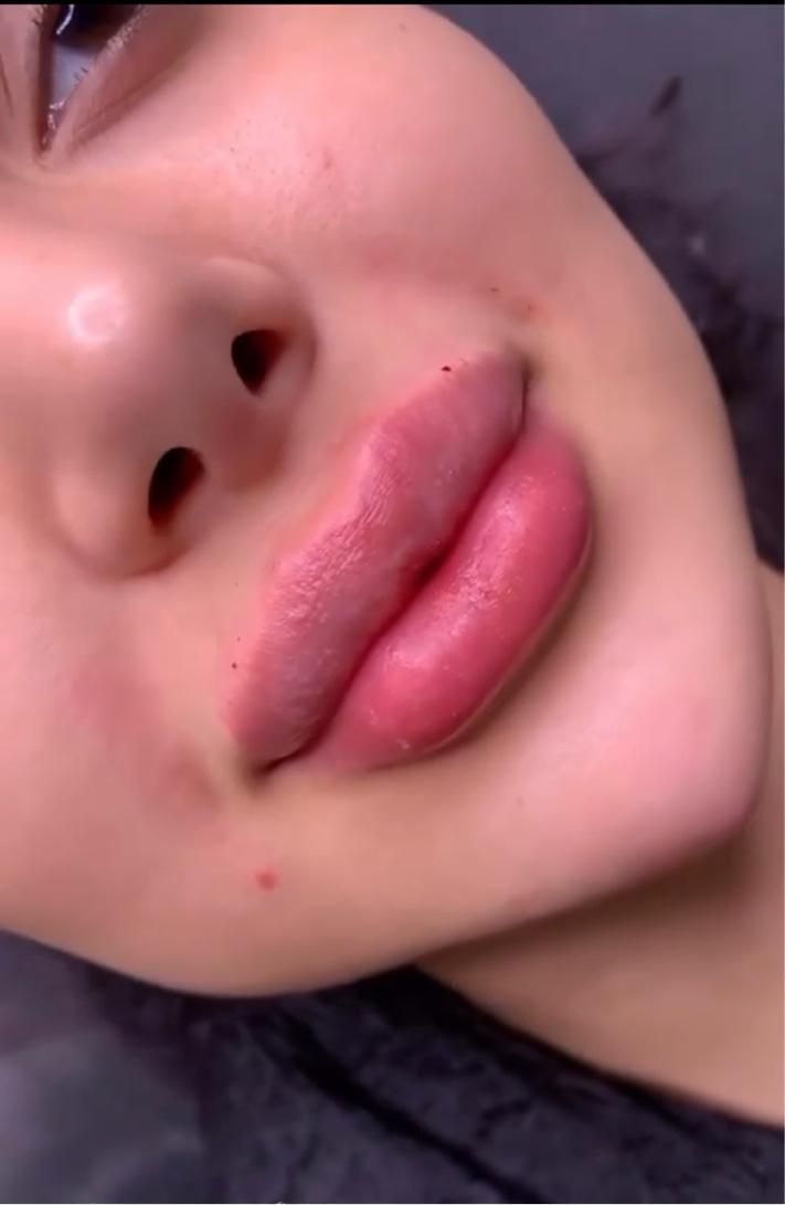 تزریق ژل لب .زاویه فک . بوتاکس. فیلر چانه.|خدمات آرایشگری و زیبایی|تهران, تهرانپارس غربی|دیوار