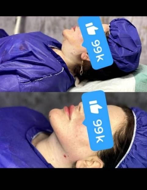 ساکشن غبغب با پال دیجیتالی و اندولیفت پوست اضافه|خدمات آرایشگری و زیبایی|مشهد, سناباد|دیوار