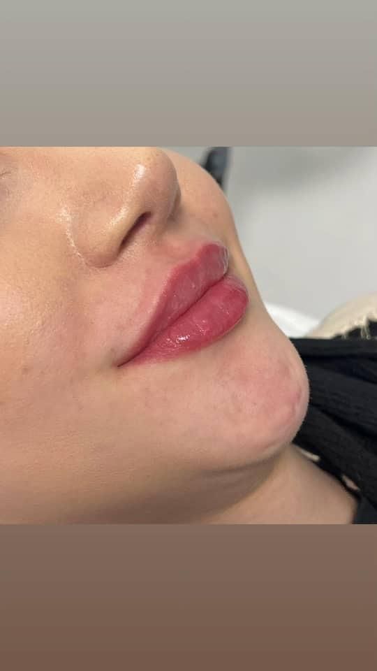 تزریق فول فیس صورت،فیلر لب وزاویه سازی|خدمات آرایشگری و زیبایی|شیراز, شهرک ایثار|دیوار