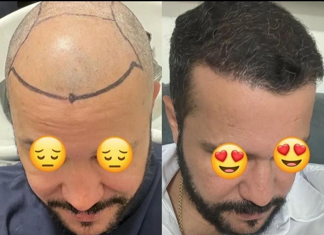 جشنواره‌کاشت مو و ابرو و ریش و‌سبیل|خدمات آرایشگری و زیبایی|قم, آزادگان|دیوار
