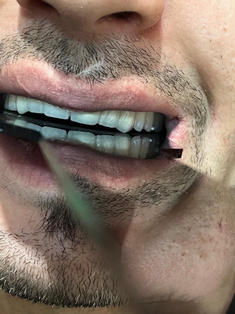 روکش های دندانی(پروتز های دندانی)|خدمات آرایشگری و زیبایی|ارومیه, |دیوار