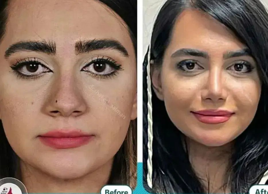 زیبایی بینی|خدمات آرایشگری و زیبایی|تهران, فاطمی|دیوار