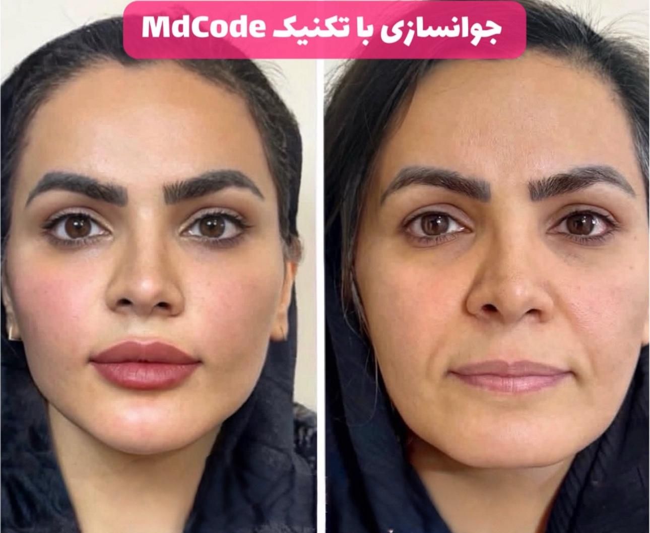 ژل لب روسی بوتاکس کانتورینگ و مادلینگ صورت لیفت نخ|خدمات آرایشگری و زیبایی|تهران, سعادت‌آباد|دیوار