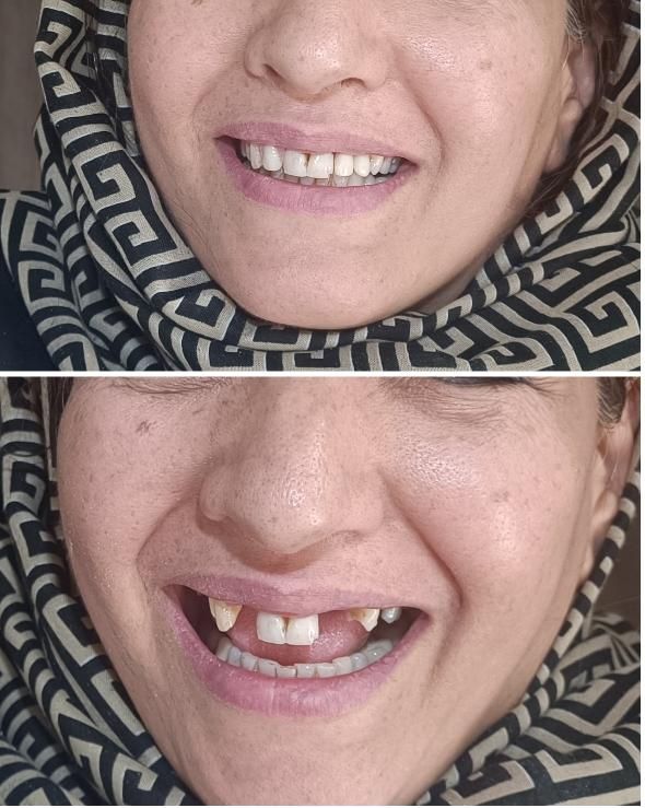 دندان دندانسازی پروتز با چک|خدمات آرایشگری و زیبایی|مشهد, موعود|دیوار