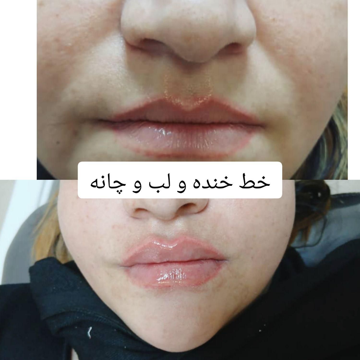 بوتاکس ژل فیلر فیلربادی مزوتراپی پی آر پی در مطب|خدمات آرایشگری و زیبایی|زنجان, |دیوار