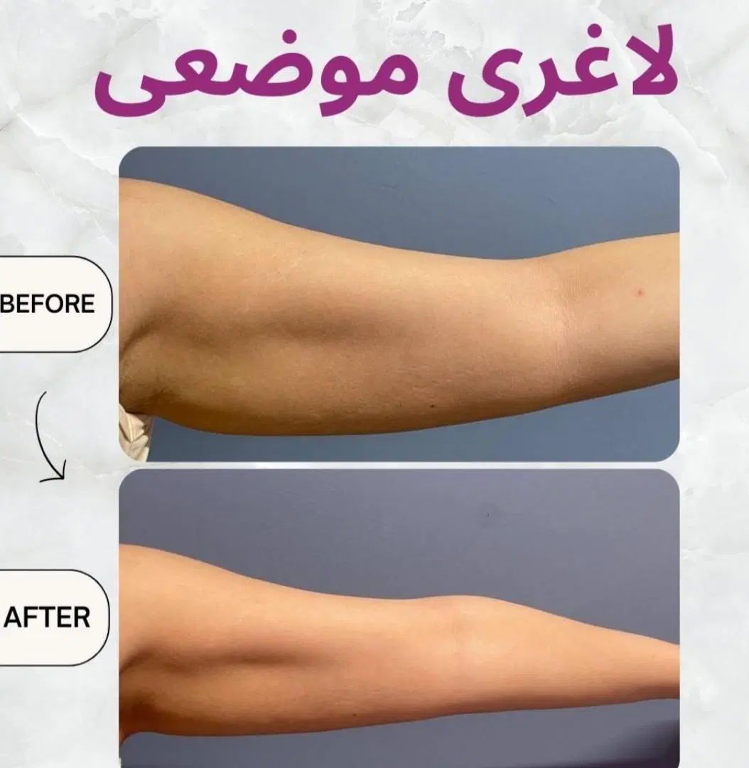 لاغری تضمینی تا ۵۰ درصد تخفیف و یک جلسه هدیه|خدمات آرایشگری و زیبایی|تهران, شهرک صادقیه|دیوار