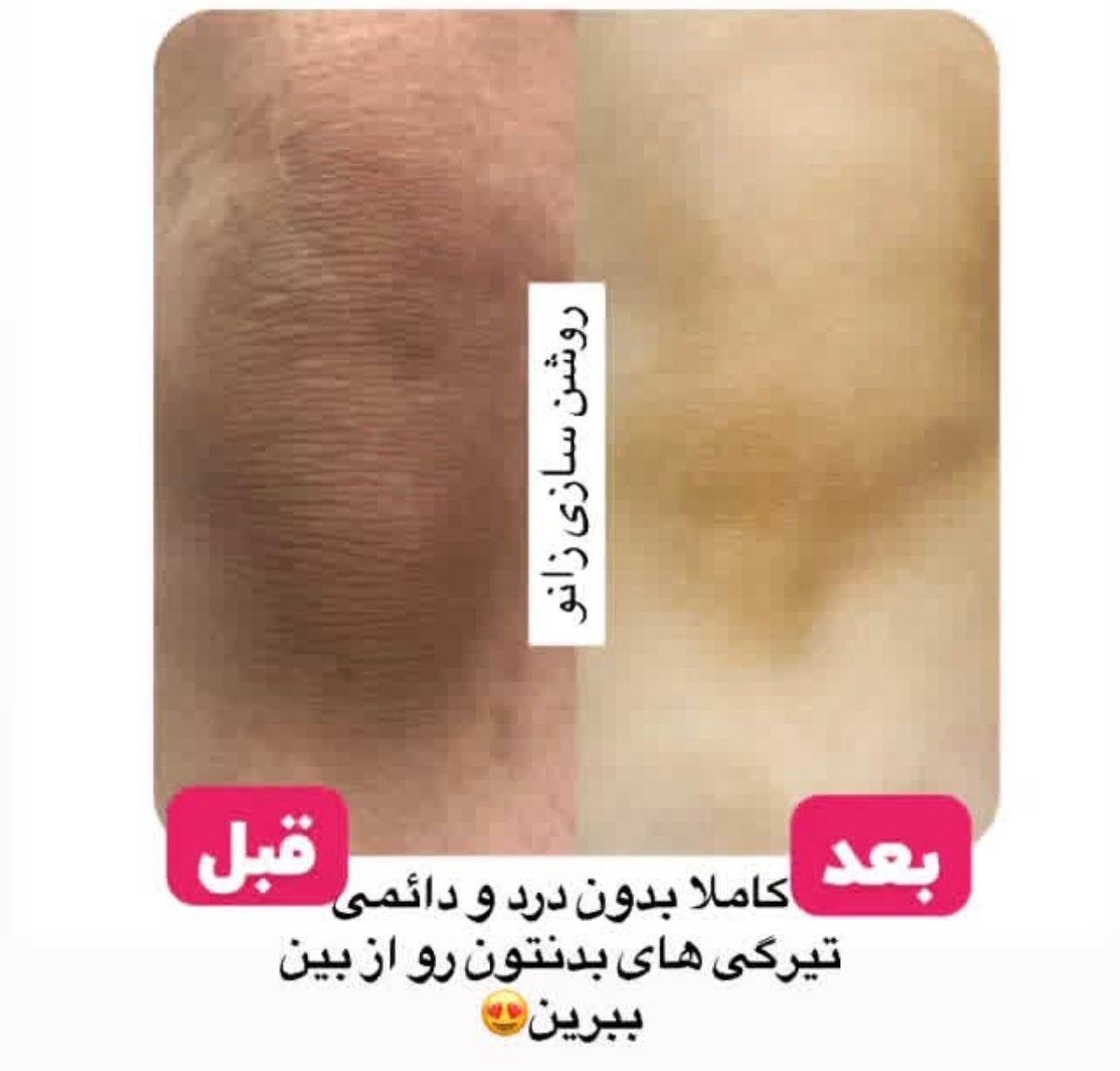 تخفیف لیزر اشنایدرپلاس و روشن سازی نواحی تیره|خدمات آرایشگری و زیبایی|بندرعباس, |دیوار