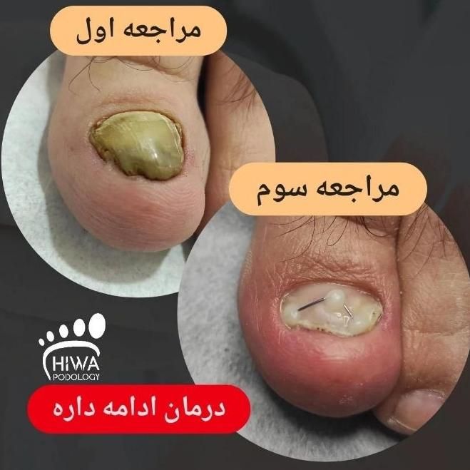 درمان بیماری ناخن و ارتونیل (پودولوژی)|خدمات آرایشگری و زیبایی|اصفهان, سعادت‌آباد|دیوار