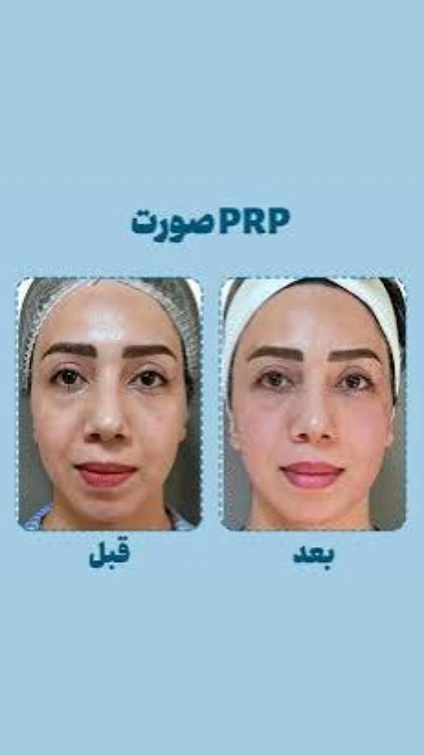 پی آر پی مو و صورت  فقط ۱۱۰۰|خدمات آرایشگری و زیبایی|محمدیه-قزوین, |دیوار