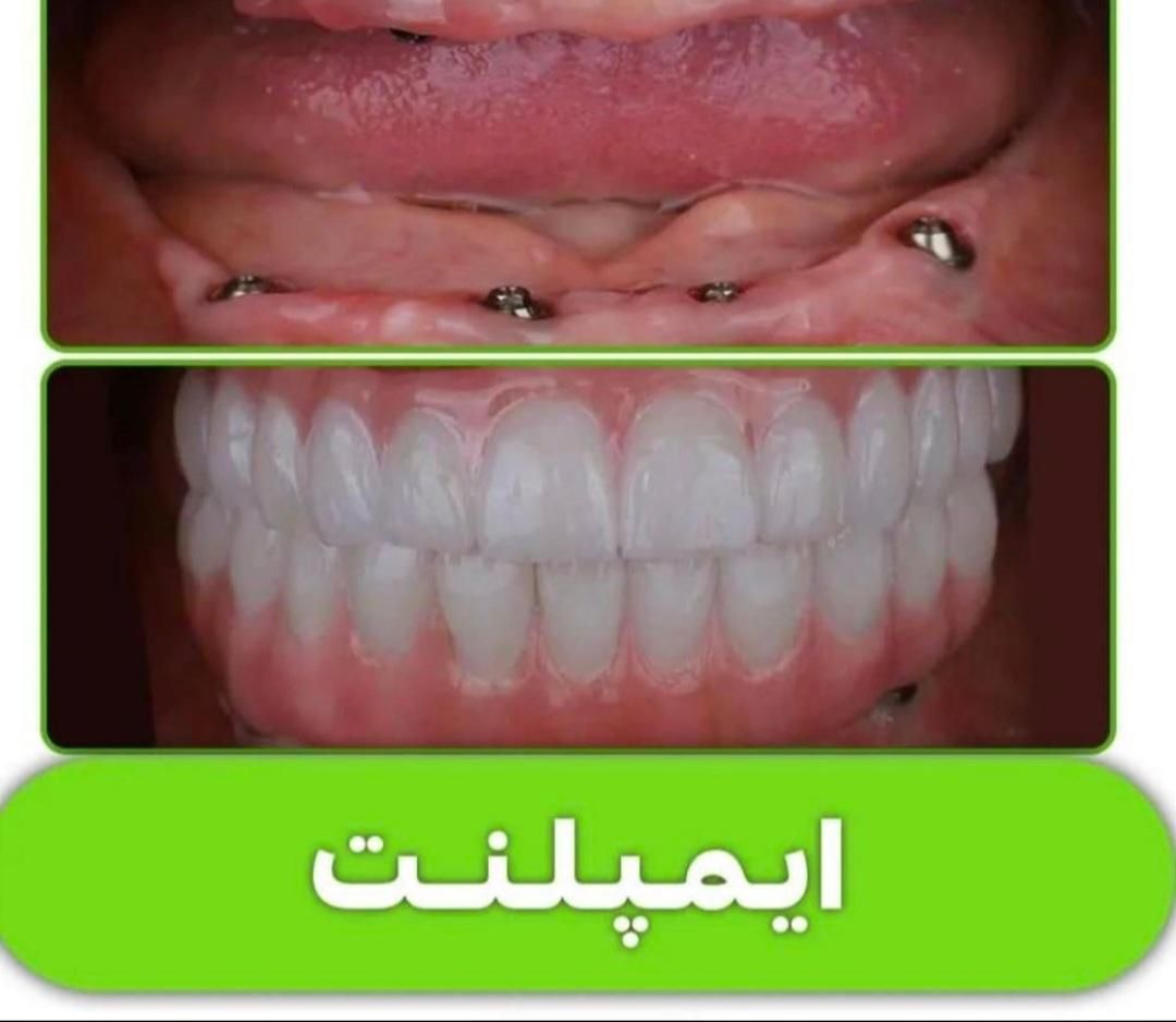 ایمپلنت تخصصی دندانپزشکی توسط ایمپلنتولوژیست فارس|خدمات آرایشگری و زیبایی|شیراز, قصرالدشت|دیوار