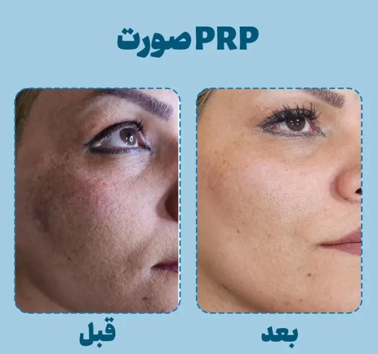 خال برداری، پی آر پی ،پرسینگ بوتاکس|خدمات آرایشگری و زیبایی|مشهد, موسوی قوچانی|دیوار