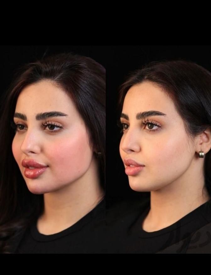 تزریق ژل و بوتاکس فقط ۵۰۰هزارتومان|خدمات آرایشگری و زیبایی|فولادشهر, B2|دیوار