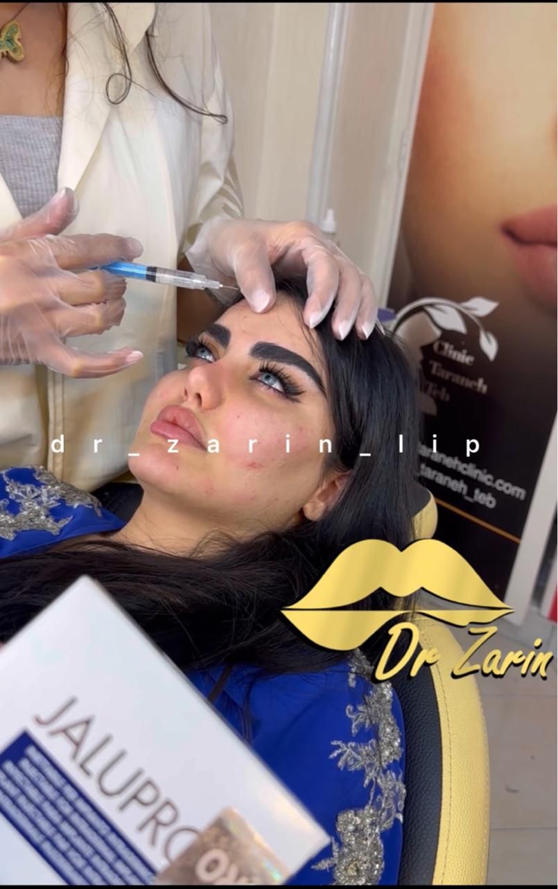 تزریق تخصصی فیلر زیر چشم بینی ژل لب روسی لیفت گونه|خدمات آرایشگری و زیبایی|تهران, پونک|دیوار