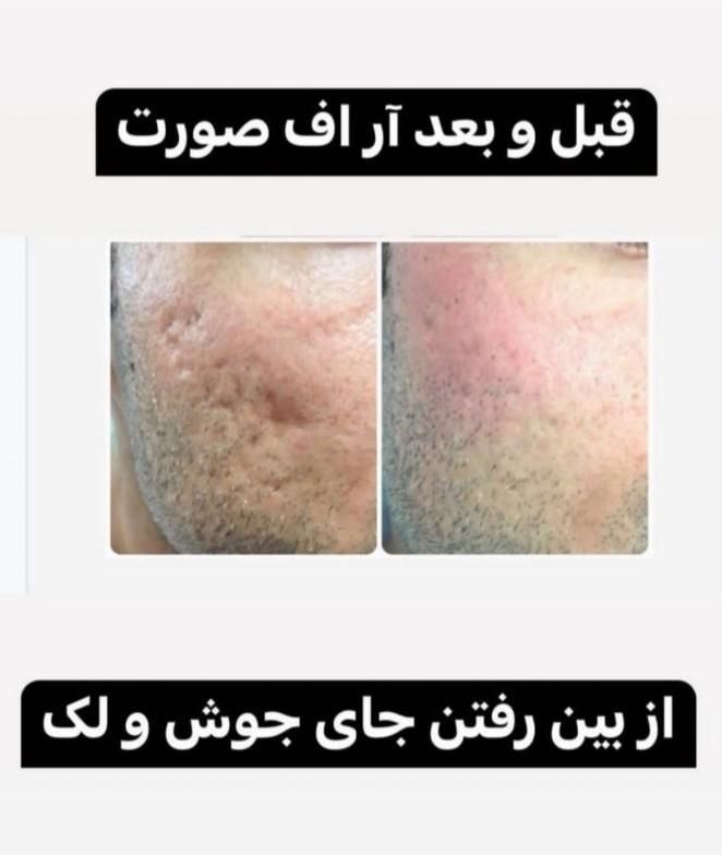 لیزر مو های زائد بانوان و آقایان، تضمینی|خدمات آرایشگری و زیبایی|تهران, تهرانپارس غربی|دیوار