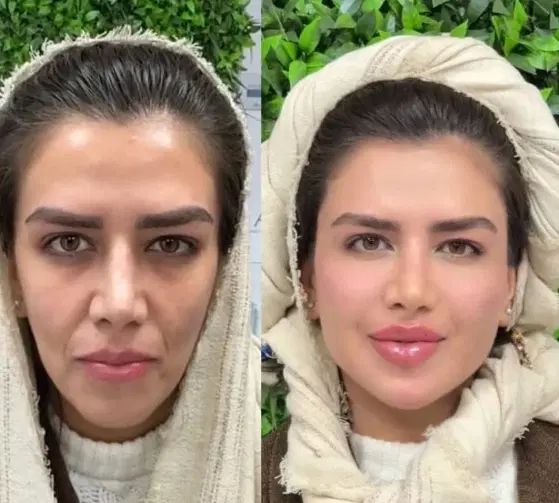 ژل بوتاکس فیلر فیشیال مزوتراپی توسط پزشک مجرب|خدمات آرایشگری و زیبایی|شهریار, شهریار|دیوار