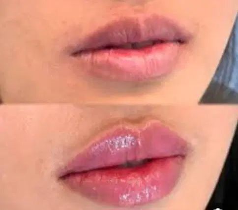 تزریق فیلر ژل وبوتاکس فشیال|خدمات آرایشگری و زیبایی|تهران, ائمه اطهار|دیوار
