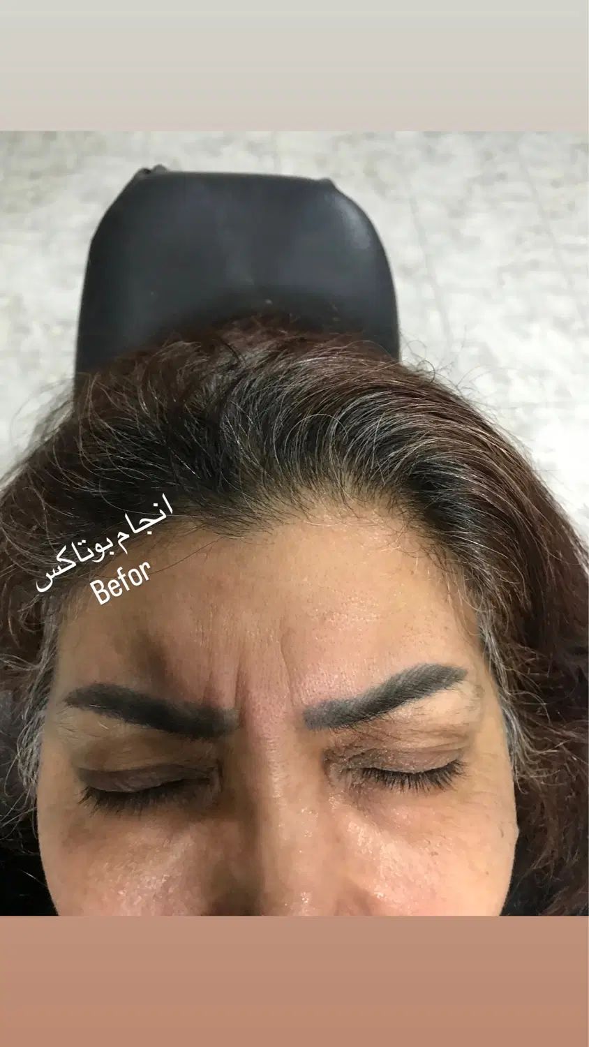 پاکسازی و فیشیال پوست  ازبین بردن لک مخصوص بانوان|خدمات آرایشگری و زیبایی|آمل, |دیوار