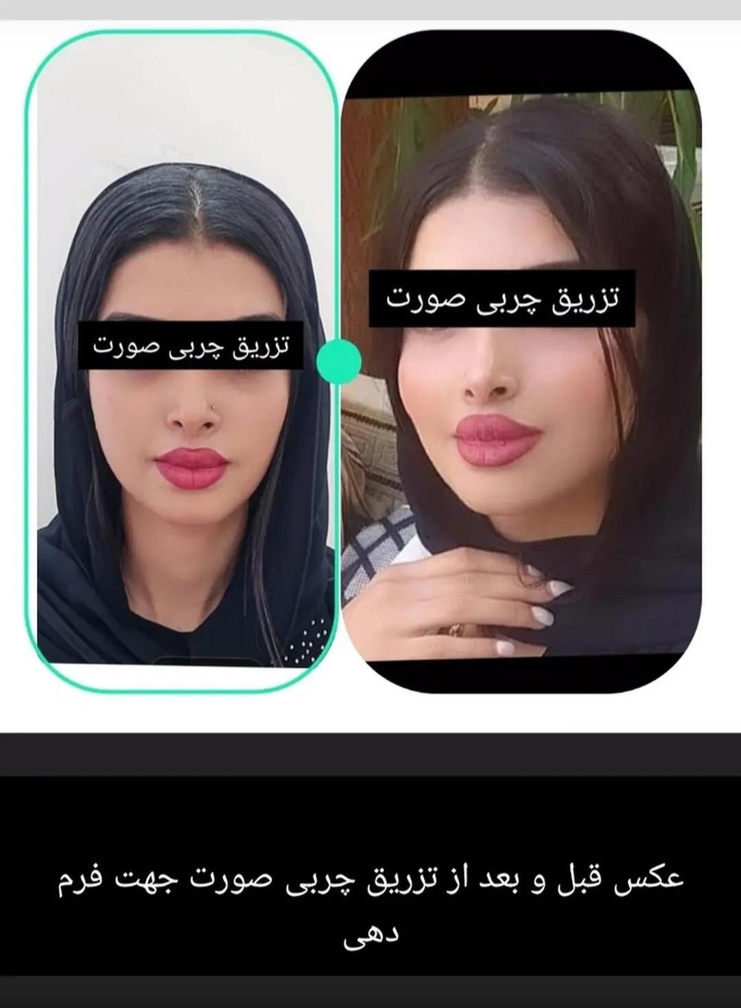 تزریق چربی، بلفاروپلاستی پلک، بینی اتوپلاستی گوش|خدمات آرایشگری و زیبایی|تهران, ستارخان|دیوار