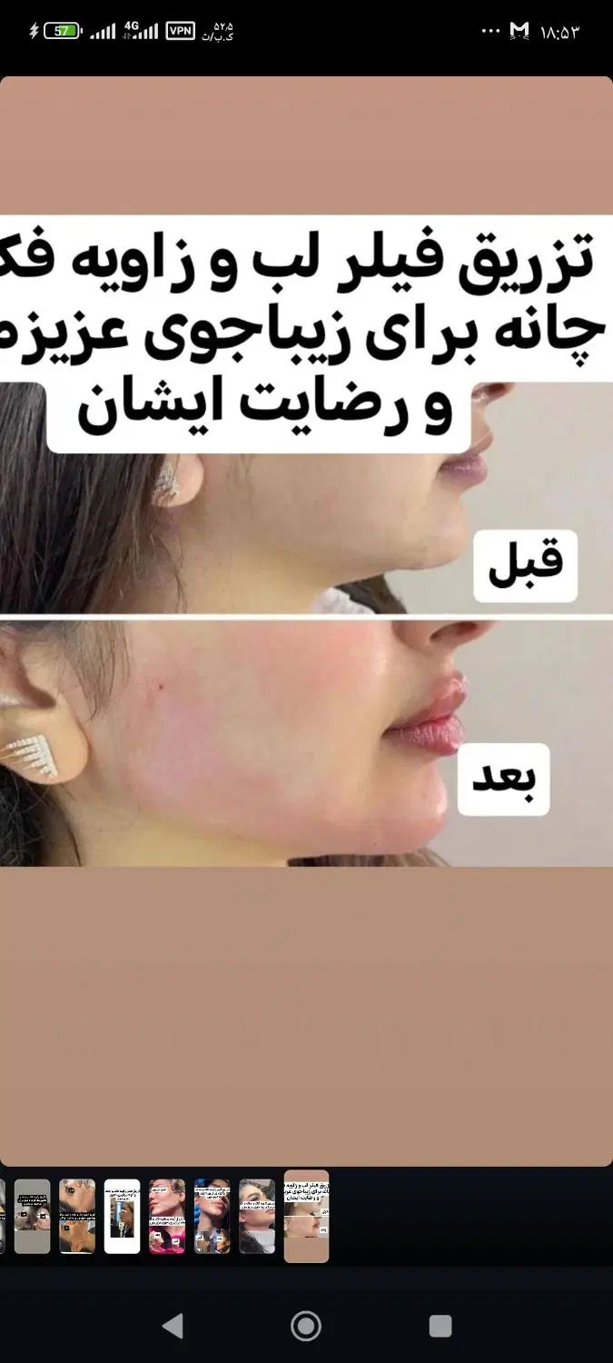 جشنواره تخفیفات یک روزه انجام فیلرزاویه فک وگونه|خدمات آرایشگری و زیبایی|تبریز, |دیوار