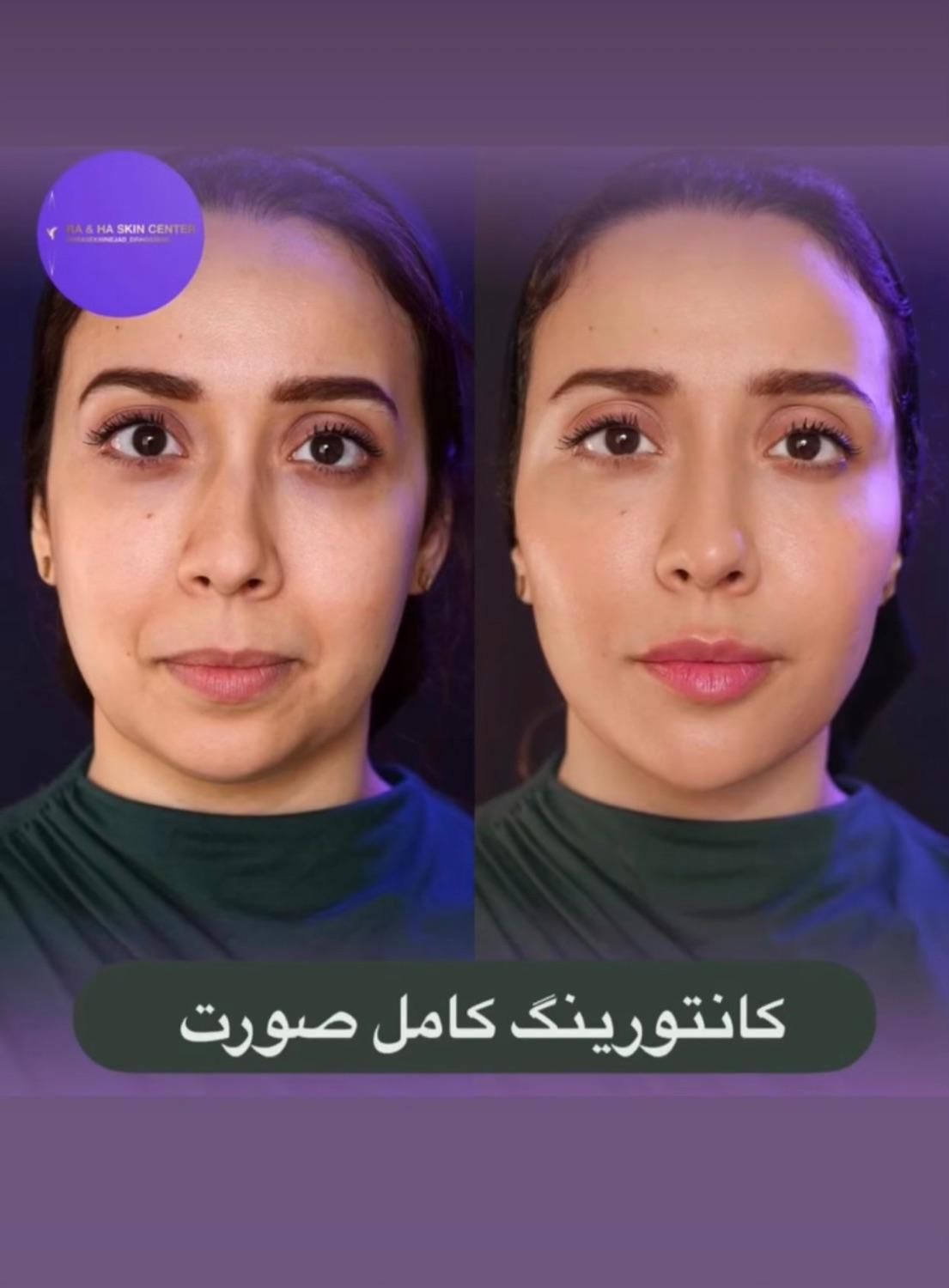 جشنواره تزریق ژل و بوتاکس در مطب پزشک بصورت اقساط|خدمات آرایشگری و زیبایی|یزد, |دیوار