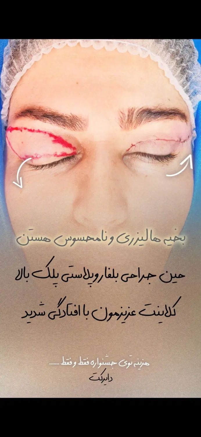 بلفاروپلاستی ، لیپو غبغب، تزریقات جوانساز|خدمات آرایشگری و زیبایی|تهران, دهم فروردین|دیوار