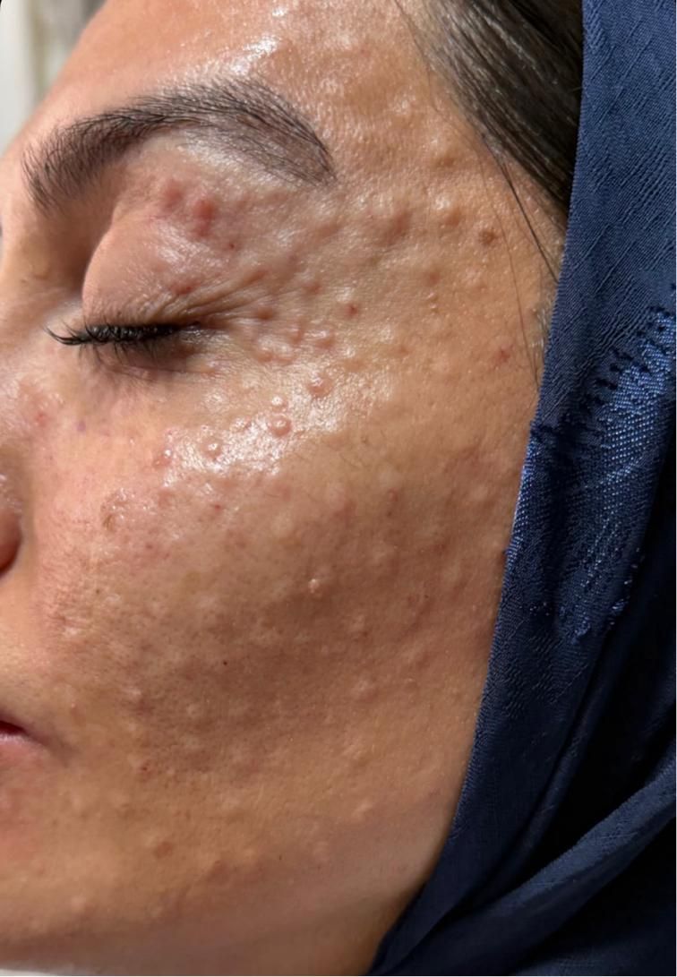 جشنواره تخفیفات ویژه مزوتراپی پوست و مو درکلینیک|خدمات آرایشگری و زیبایی|اصفهان, درب کوشک|دیوار