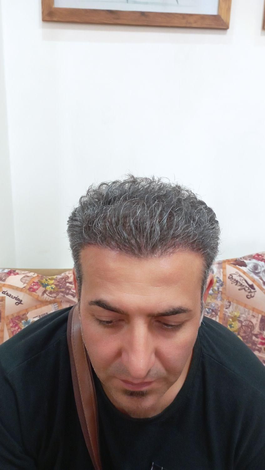 جشنواره کاشت مو و ابرو|خدمات آرایشگری و زیبایی|تهران, افسریه شمالی|دیوار