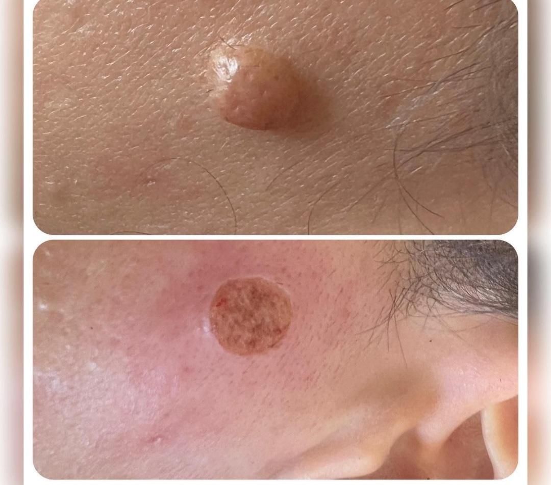 برداشتن انواع خال وزیگل با دستگاه لیزر پیشرفته|خدمات آرایشگری و زیبایی|ارومیه, |دیوار